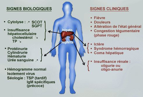 Les fièvres infectieuses graves Médecine Intégrée